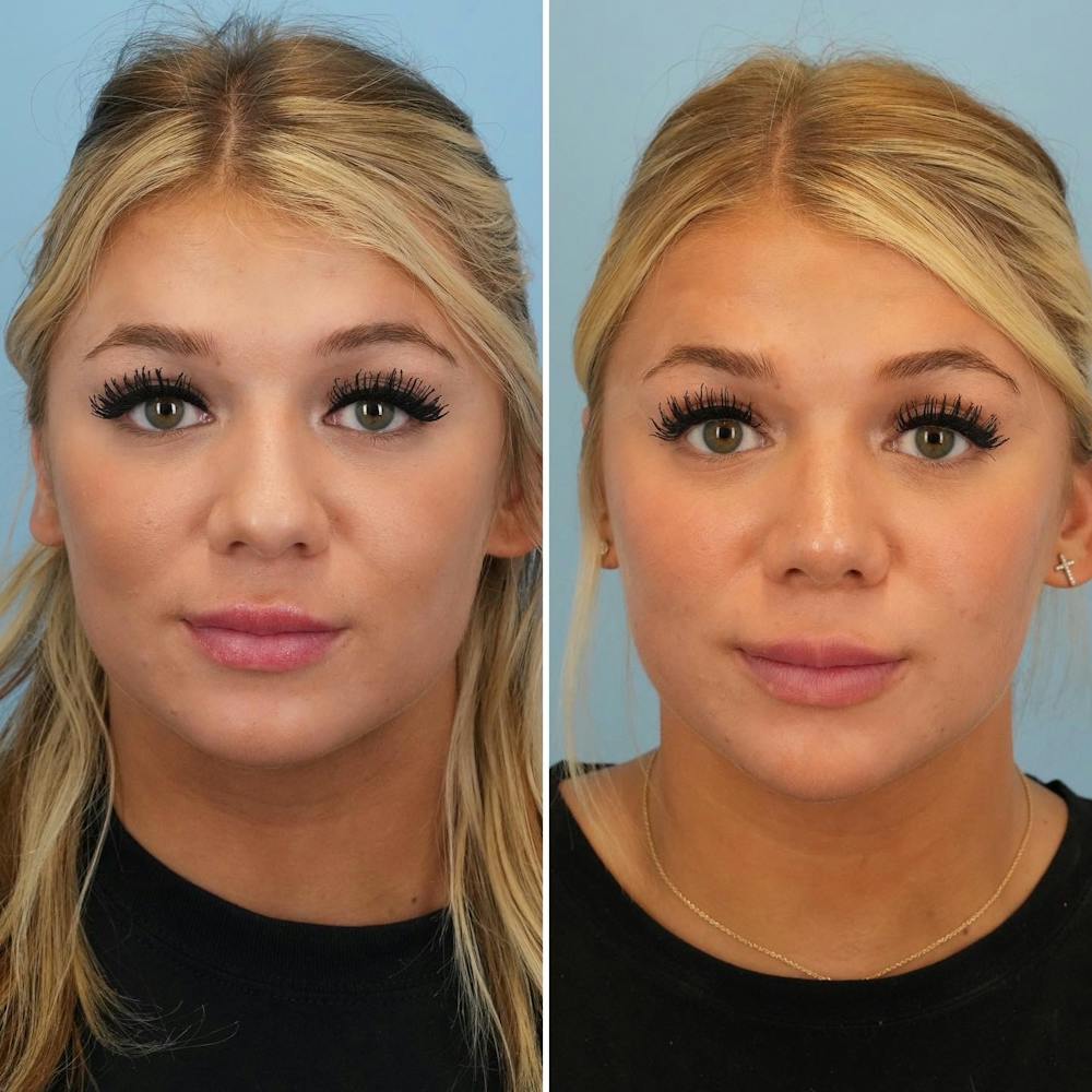 Rhinoplasty Before & After Gallery - Patient 176984798 - Image 3