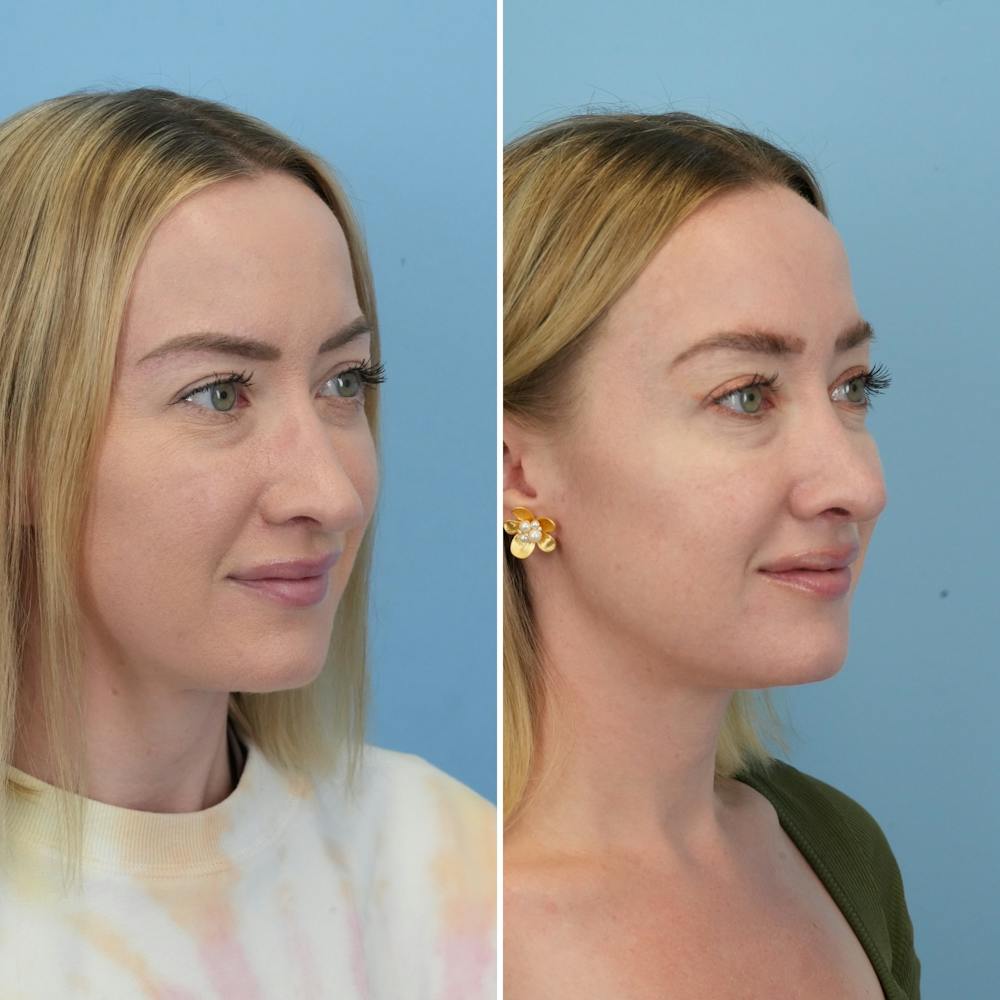 Rhinoplasty Before & After Gallery - Patient 176984818 - Image 3