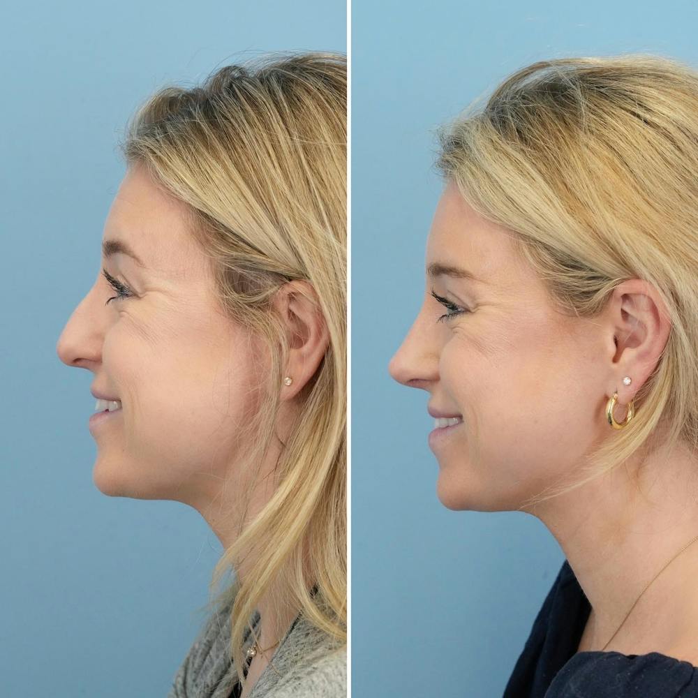 Rhinoplasty Before & After Gallery - Patient 176984806 - Image 1