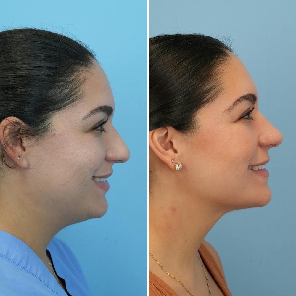 Rhinoplasty Before & After Gallery - Patient 176984795 - Image 4