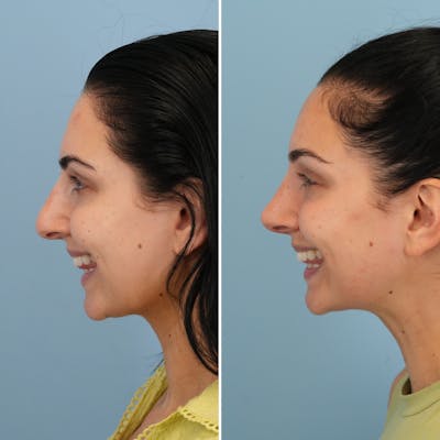 Rhinoplasty Before & After Gallery - Patient 176984803 - Image 2