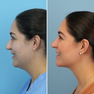 Rhinoplasty Before & After Gallery - Patient 176984795 - Image 2