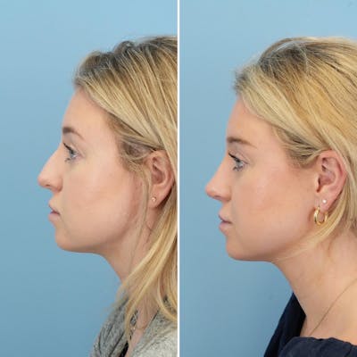 Rhinoplasty Before & After Gallery - Patient 176984806 - Image 2