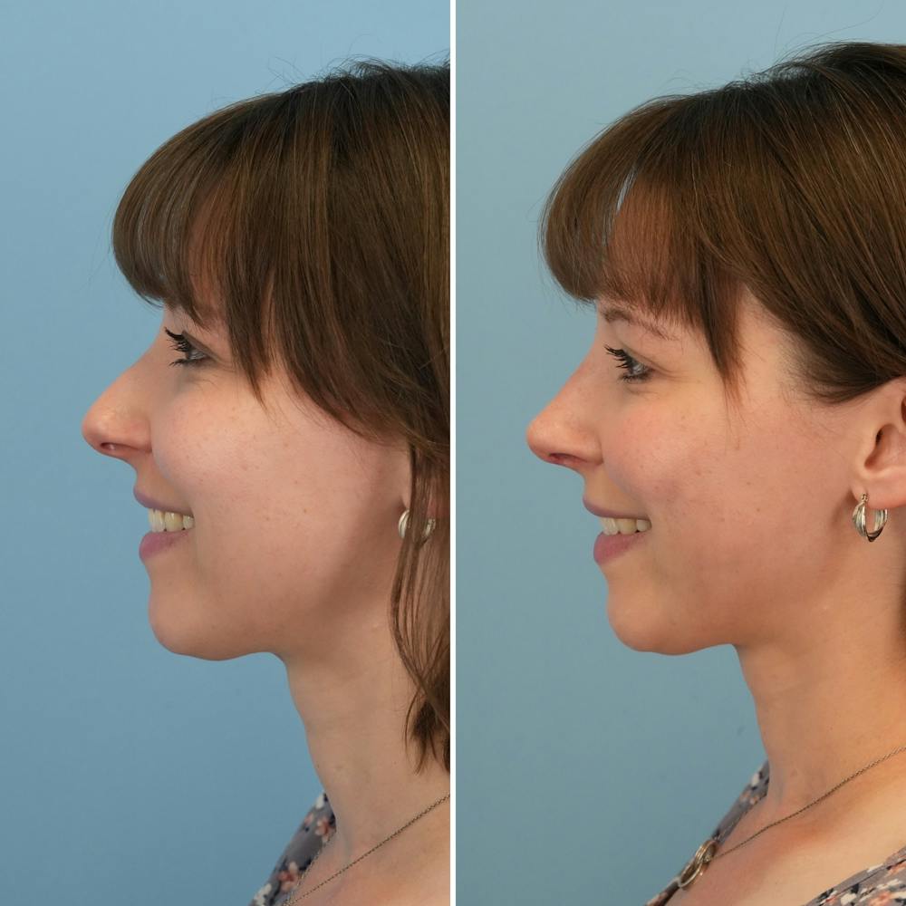 Rhinoplasty Before & After Gallery - Patient 176984799 - Image 2