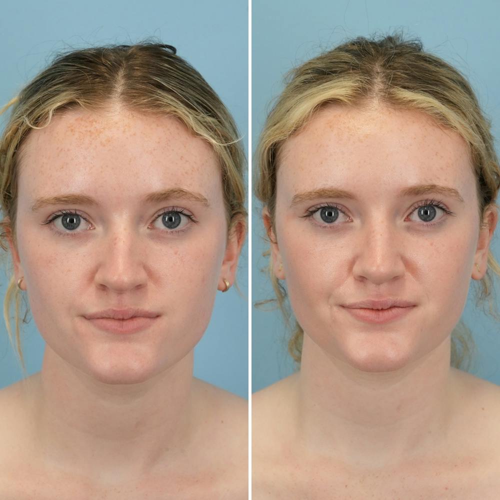 Rhinoplasty Before & After Gallery - Patient 176984806 - Image 4
