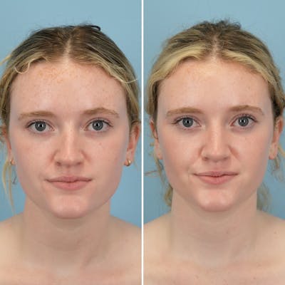 Rhinoplasty Before & After Gallery - Patient 176984806 - Image 4