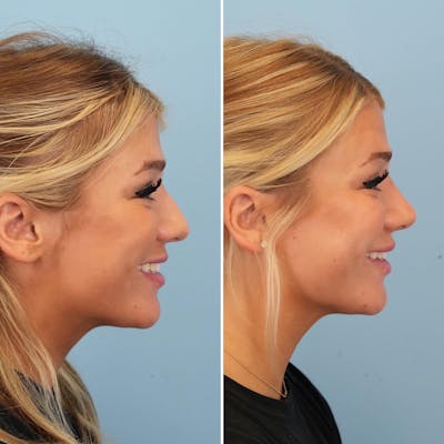 Rhinoplasty Before & After Gallery - Patient 176984798 - Image 4