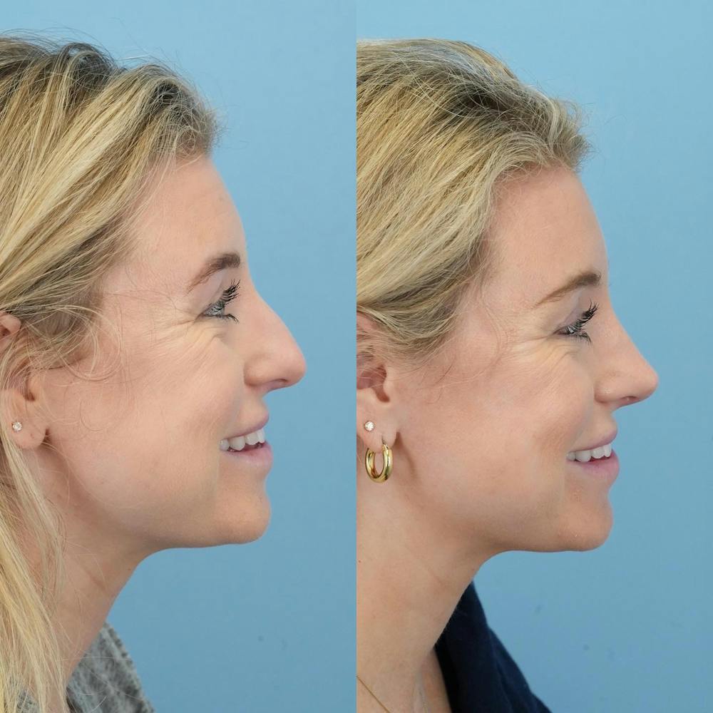 Rhinoplasty Before & After Gallery - Patient 176984806 - Image 3