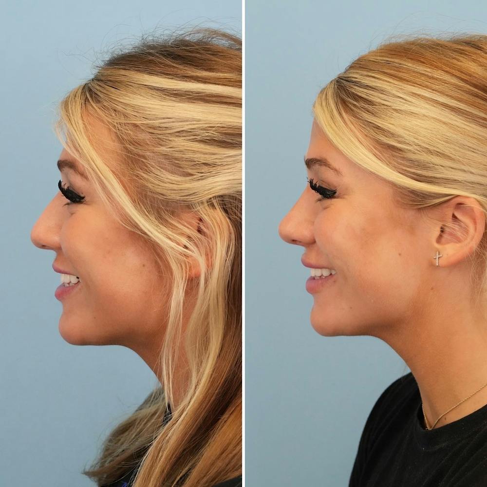 Rhinoplasty Before & After Gallery - Patient 176984798 - Image 5