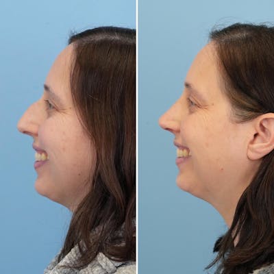 Rhinoplasty Before & After Gallery - Patient 176984804 - Image 4