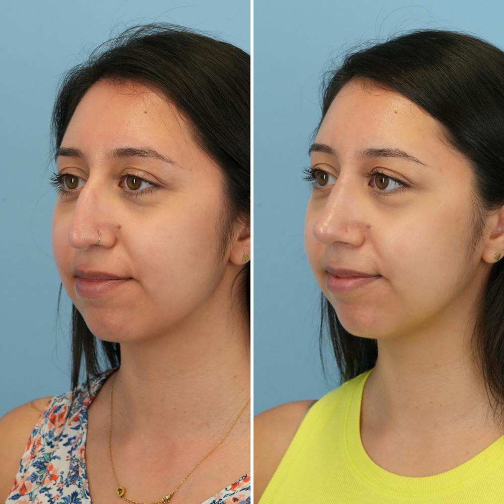 Rhinoplasty Before & After Gallery - Patient 176984817 - Image 7