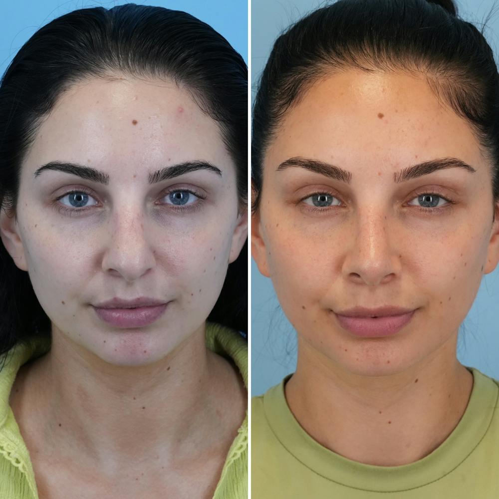 Rhinoplasty Before & After Gallery - Patient 176984803 - Image 7