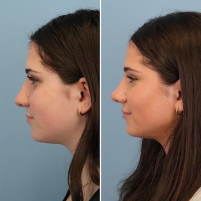 Rhinoplasty Before & After Gallery - Patient 176984807 - Image 1