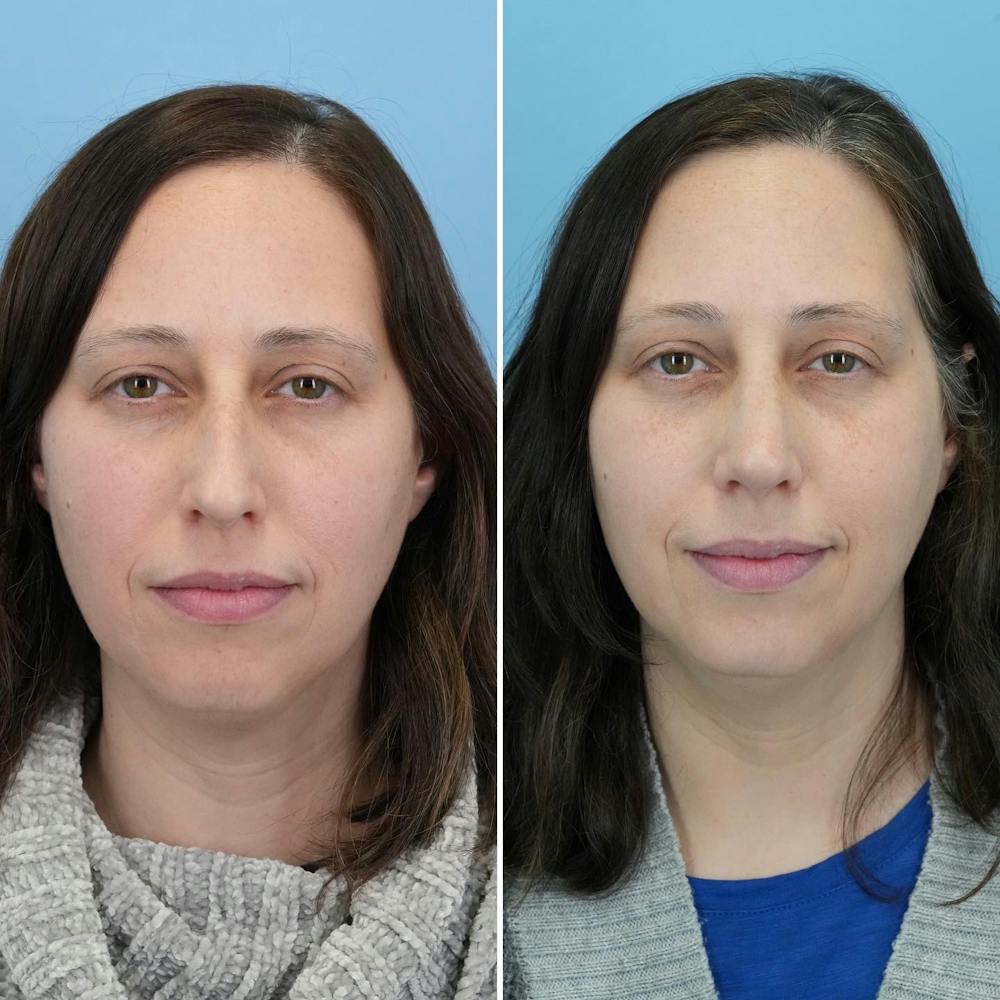 Rhinoplasty Before & After Gallery - Patient 176984804 - Image 5