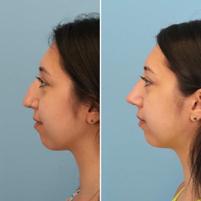 Rhinoplasty Before & After Gallery - Patient 176984817 - Image 2