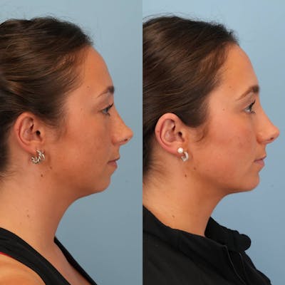 Chin Implants Before & After Gallery - Patient 706867 - Image 4