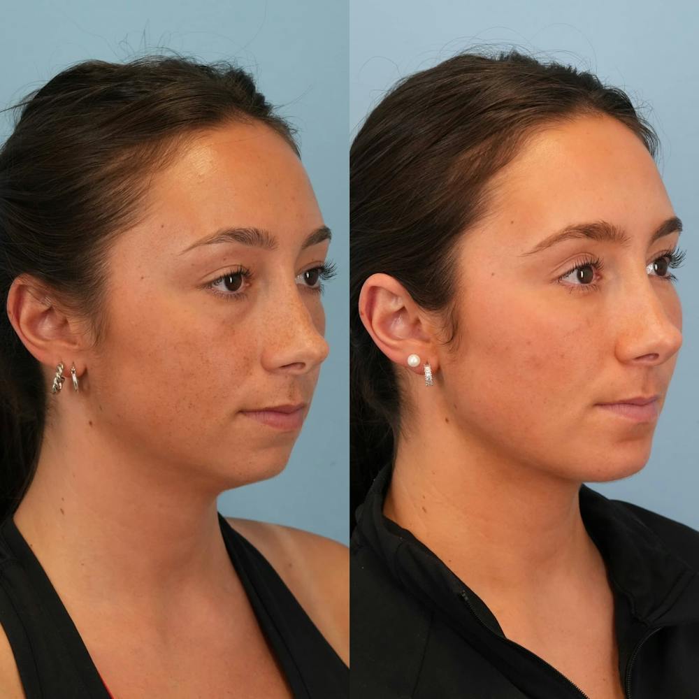 Chin Implants Before & After Gallery - Patient 706867 - Image 5
