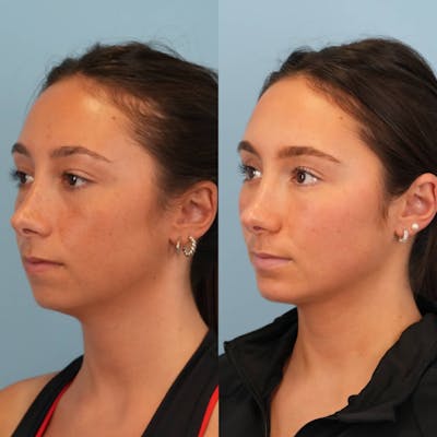 Chin Implants Before & After Gallery - Patient 706867 - Image 1