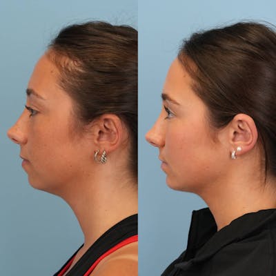 Chin Implants Before & After Gallery - Patient 706867 - Image 2
