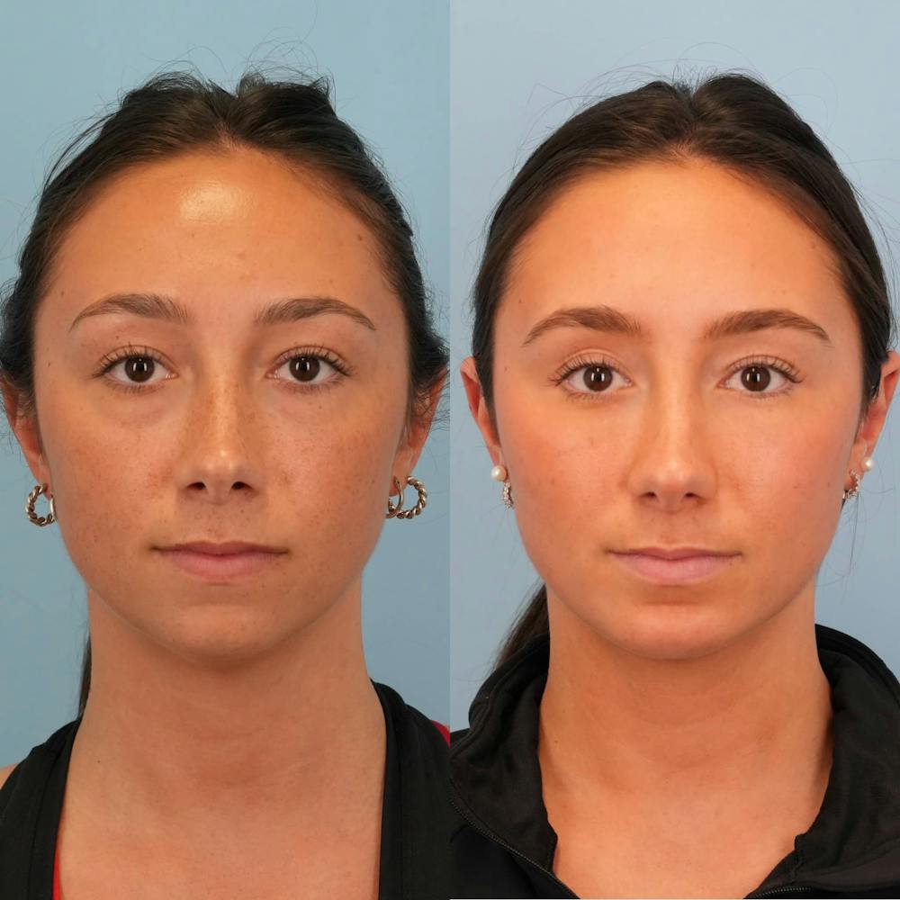 Chin Implants Before & After Gallery - Patient 706867 - Image 3