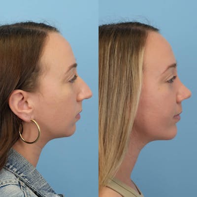 Rhinoplasty Before & After Gallery - Patient 404967 - Image 2