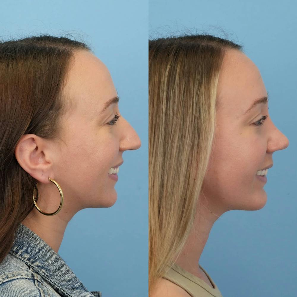 Chin Implants Before & After Gallery - Patient 126231 - Image 6