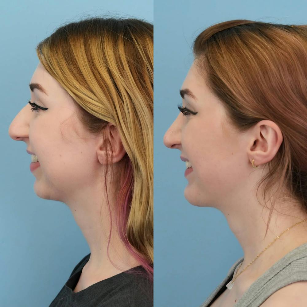 Chin Implants Before & After Gallery - Patient 230122 - Image 1