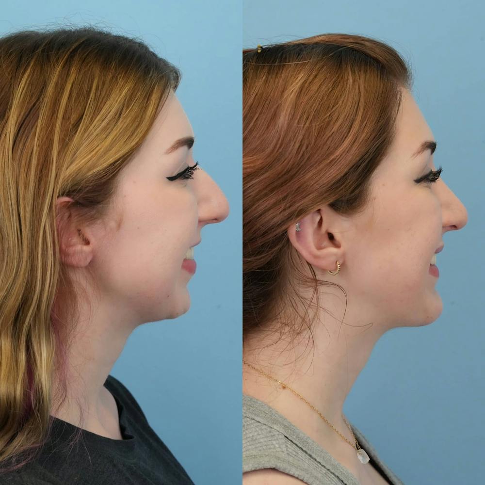 Chin Implants Before & After Gallery - Patient 230122 - Image 5