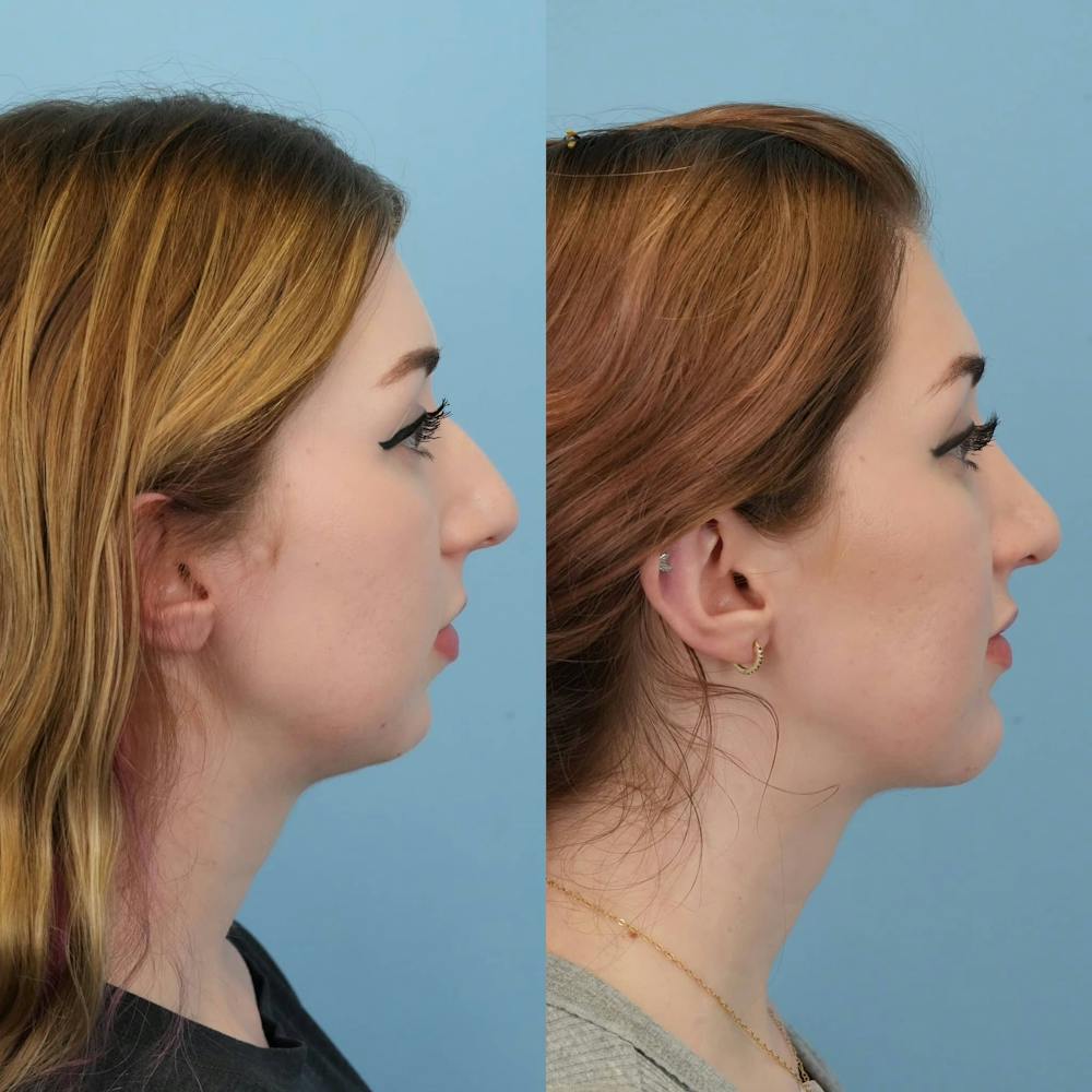 Rhinoplasty Before & After Gallery - Patient 372833 - Image 7