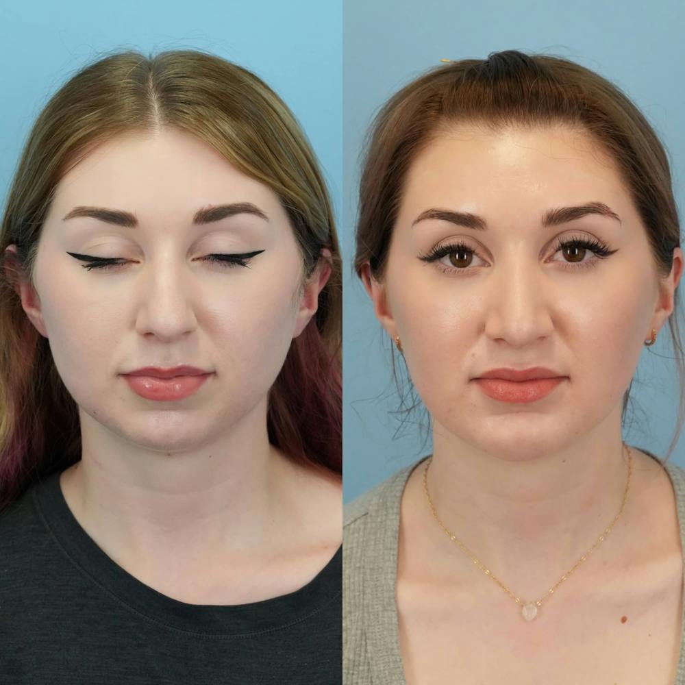 Chin Implants Before & After Gallery - Patient 230122 - Image 3
