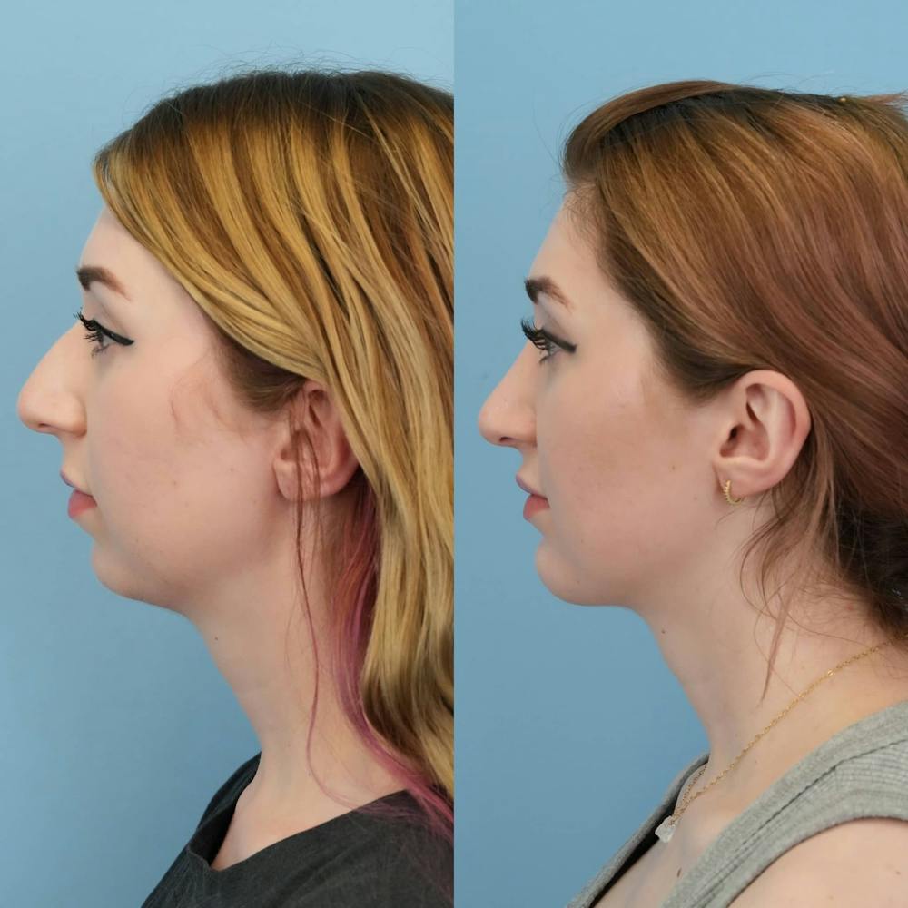 Chin Implants Before & After Gallery - Patient 230122 - Image 2