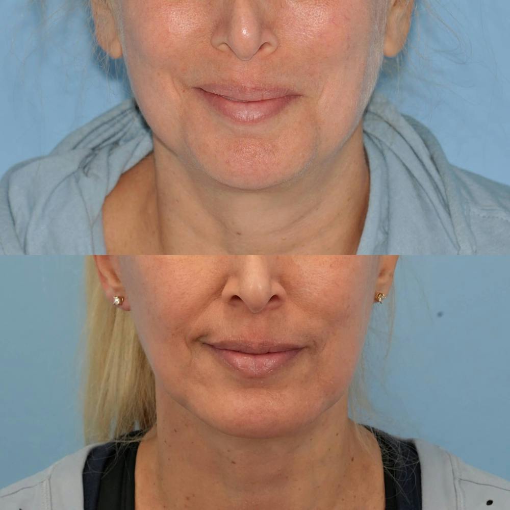 Facelift Before & After Gallery - Patient 186684 - Image 1