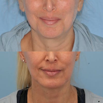 Facelift Before & After Gallery - Patient 186684 - Image 1