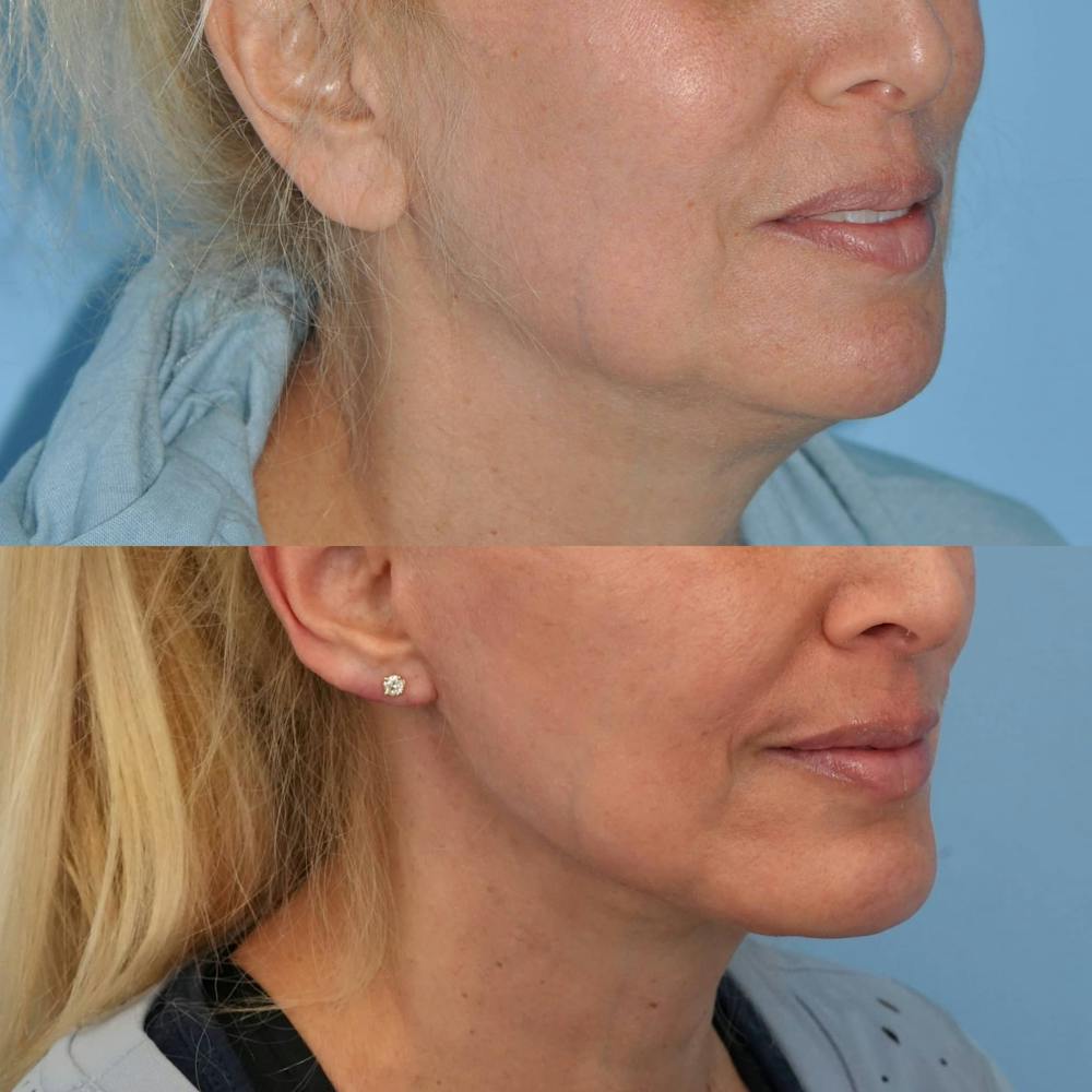 Facelift Before & After Gallery - Patient 186684 - Image 5