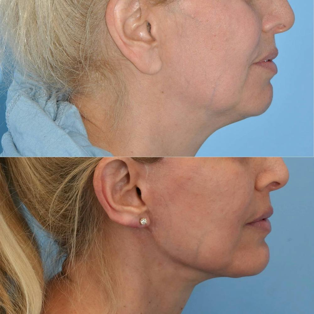 Facelift Before & After Gallery - Patient 186684 - Image 4