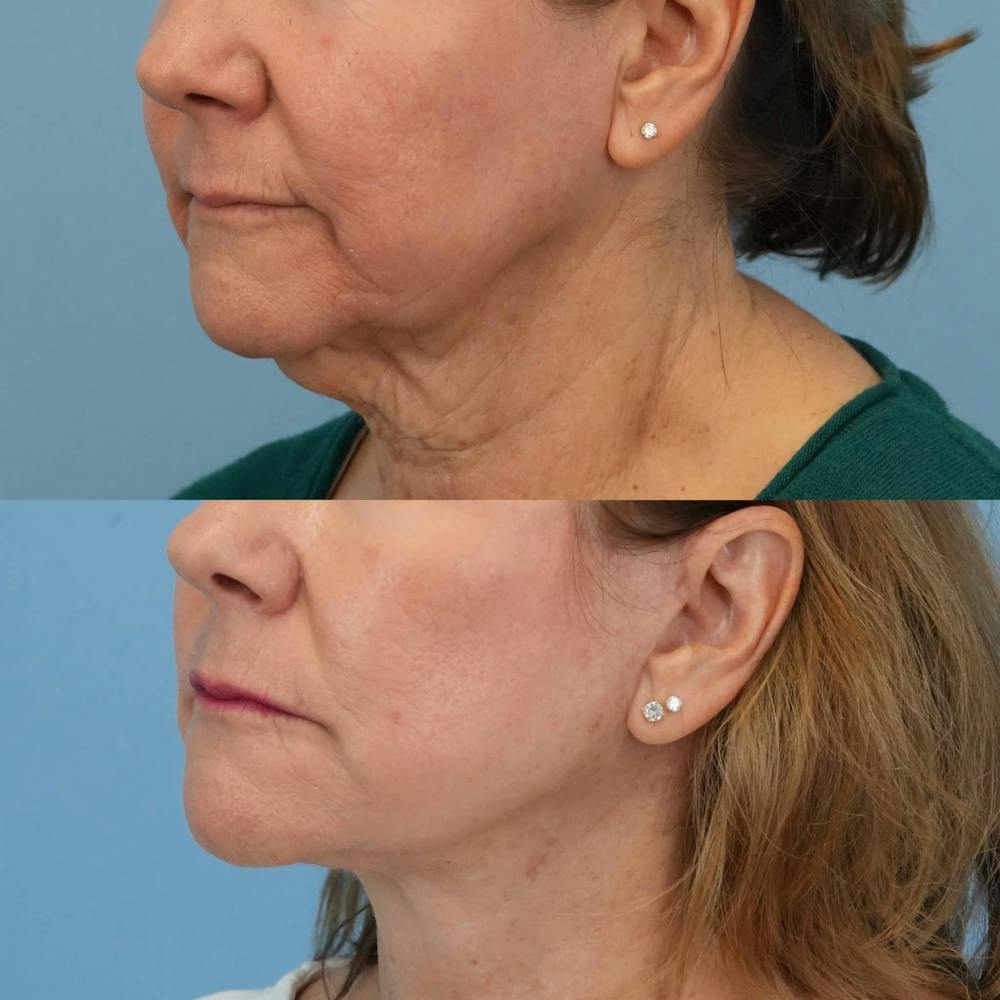 Facelift Before & After Gallery - Patient 240757 - Image 2