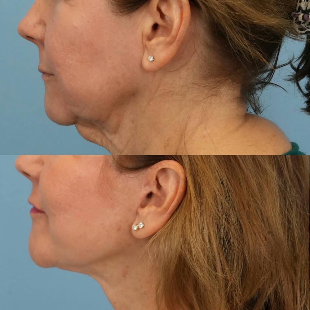 Facelift Before & After Gallery - Patient 240757 - Image 3