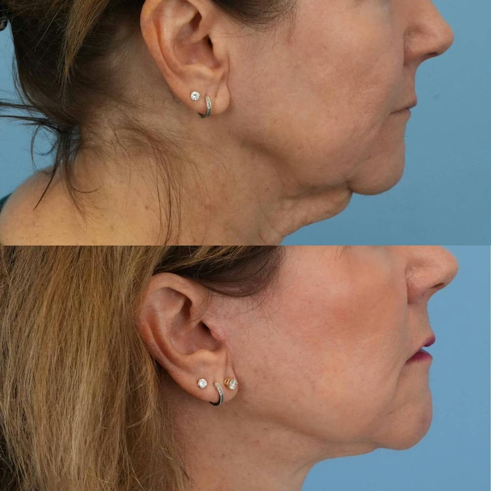 Facelift Before & After Gallery - Patient 240757 - Image 4