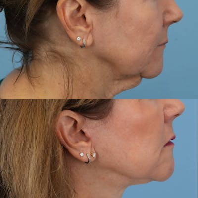 Facelift Before & After Gallery - Patient 240757 - Image 4