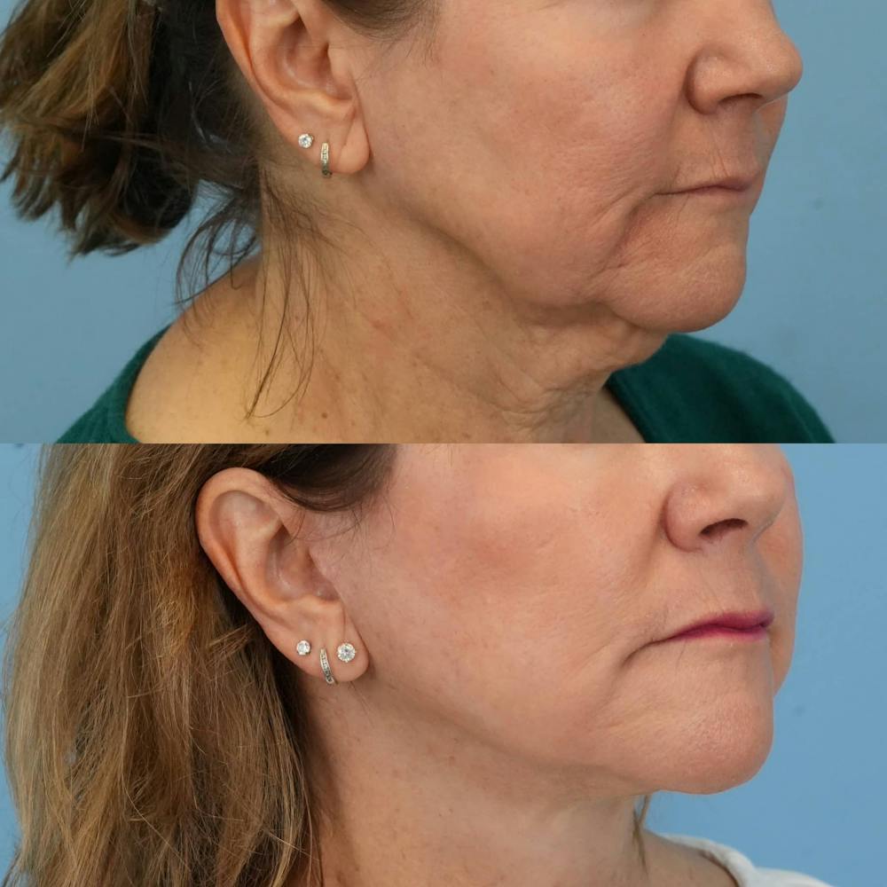 Facelift Before & After Gallery - Patient 240757 - Image 5