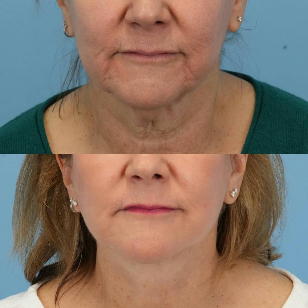 Facelift Before & After Gallery - Patient 240757 - Image 1