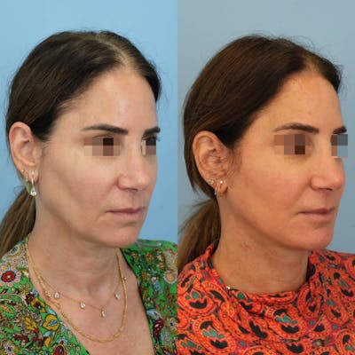 Facelift Before & After Gallery - Patient 346433 - Image 2