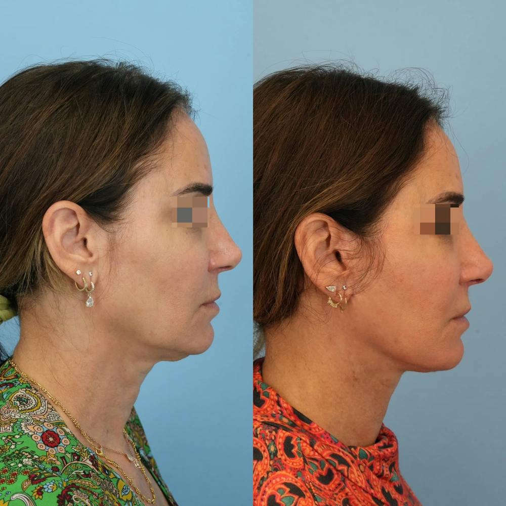 Facelift Before & After Gallery - Patient 346433 - Image 3