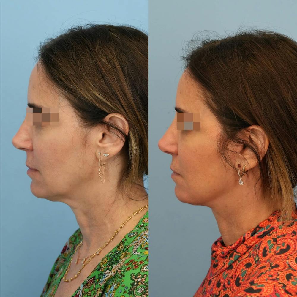 Facelift Before & After Gallery - Patient 346433 - Image 4