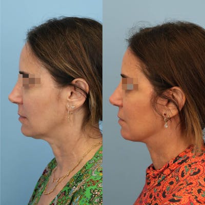 Facelift Before & After Gallery - Patient 346433 - Image 4