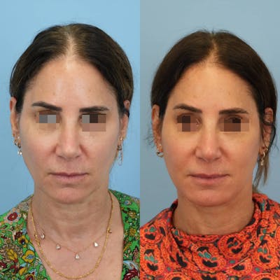 Facelift Before & After Gallery - Patient 346433 - Image 1