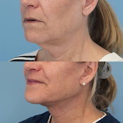 Facelift Before & After Gallery - Patient 282243 - Image 2