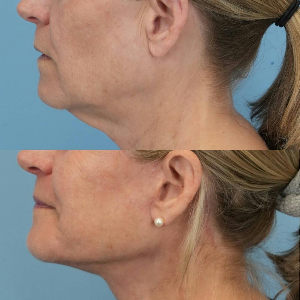 Facelift Before & After Gallery - Patient 282243 - Image 3