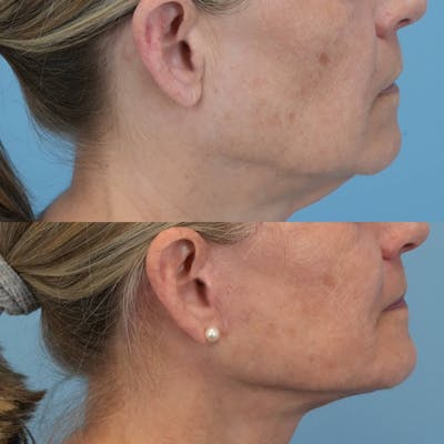 Facelift Before & After Gallery - Patient 282243 - Image 4