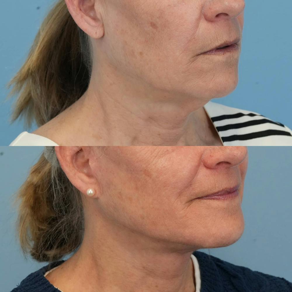 Facelift Before & After Gallery - Patient 282243 - Image 5